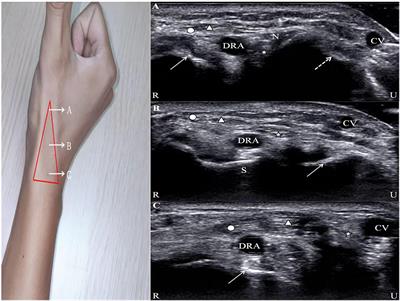 Application of ultrasound in cardiovascular intervention via the distal radial artery approach: New wine in old bottles?